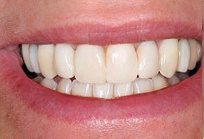 Apple Dentistry | Crowns  amp  Caps, Dental Bridges and Dental Fillings