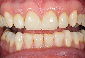 Apple Dentistry | Implant Dentistry, Pediatric Dentistry and Dentures