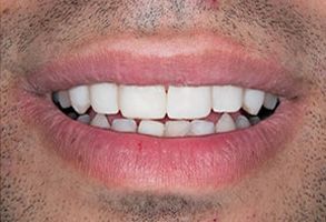 Apple Dentistry | Oral Exams, Dentures and Preventative Program