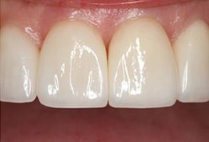 Apple Dentistry | Veneers, Night Guards and Oral Exams