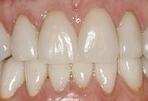 Apple Dentistry | Crowns  amp  Caps, Periodontal Treatment and Pediatric Dentistry
