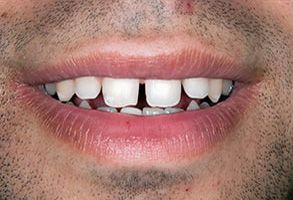 Apple Dentistry | Dental Fillings, Crowns  amp  Caps and Sedation Dentistry