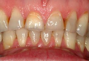 Apple Dentistry | Preventative Program, Implant Dentistry and Dental Bridges