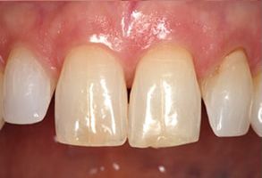 Apple Dentistry | Oral Exams, Preventative Program and Invisalign reg 