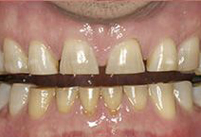 Apple Dentistry | Root Canals, Sedation Dentistry and Crowns  amp  Caps