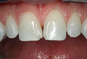 Apple Dentistry | Dentures, Dental Fillings and Dental Bridges